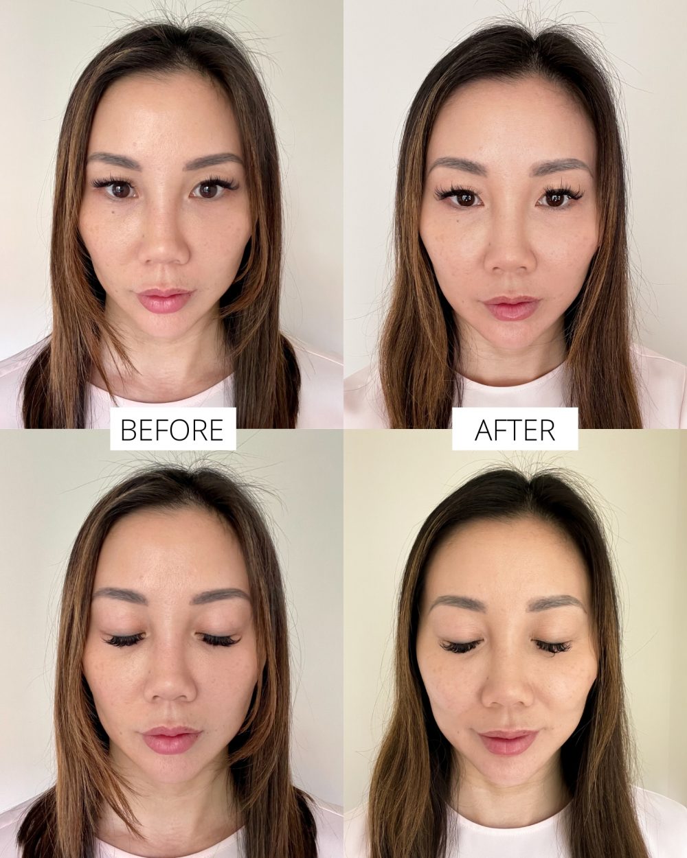 Thermage before and after results for face and eyes. Natural results 2 months later from Thermage Skin tightening