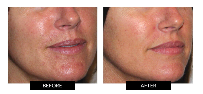  CurrentBody Skin LED Light Therapy Mask review - before and after photos