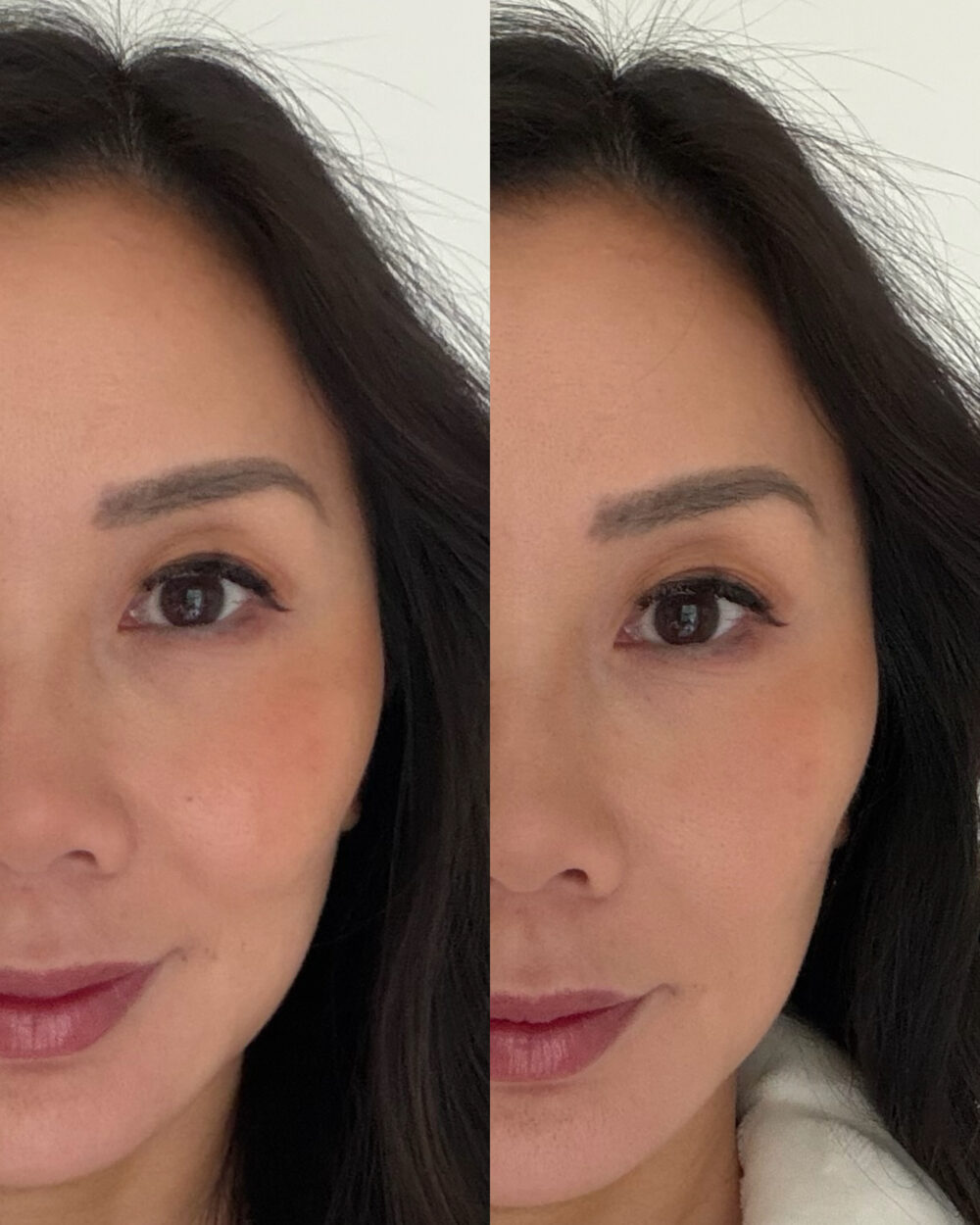 Before and after: Skin after 3 weeks of using the Lumirea DPL and NIR photofacial device